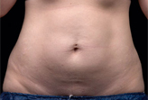 Patient # 12886 After Photo # 2